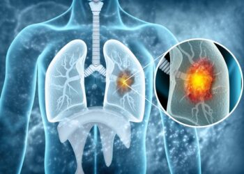 Dijagnostika brža, ali čekanje na terapiju za obolele od raka pluća i dalje traje više od mesec dana