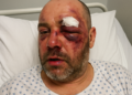 Brutalno pretučen odbornik Milivoje Brković u Podgorici: Policija pokrenula istragu